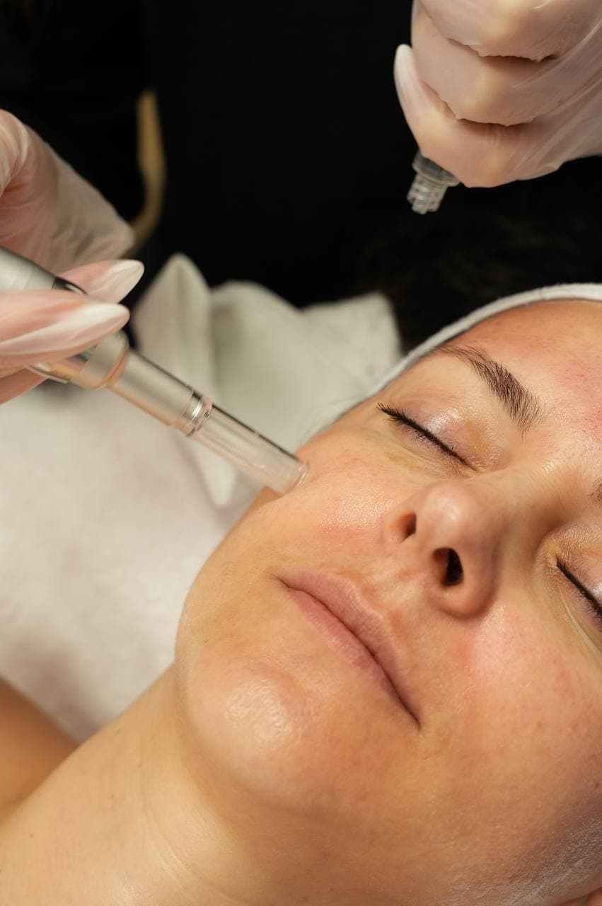 Microneedling Treatment