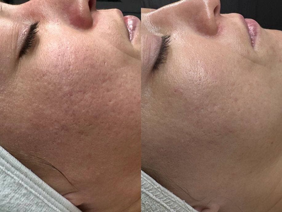 Fractional Laser Skin Resurfacing