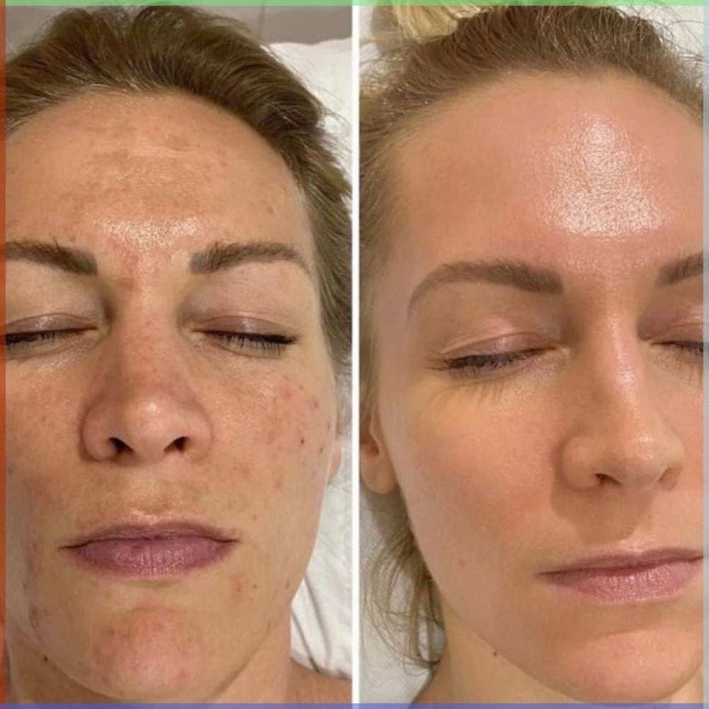 PhotoFractional Laser Treatment