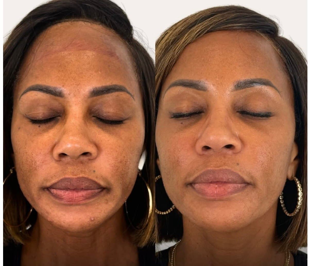 Laser Skin Toning (Q-Switched)