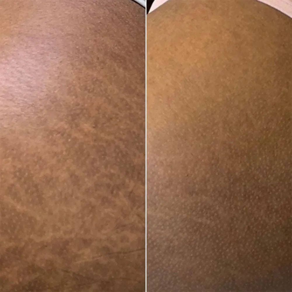 Stretch Mark Laser Treatment