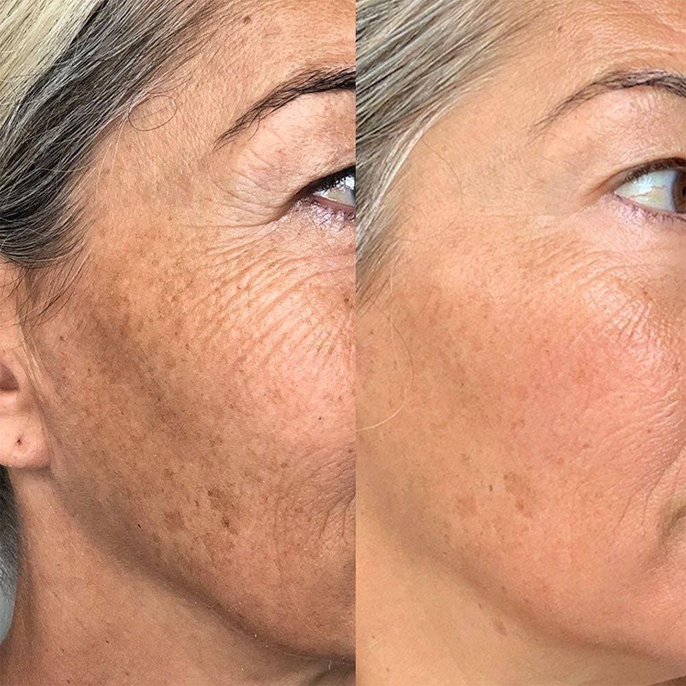 M22 XPL (Advanced IPL) Total Skin Renewal