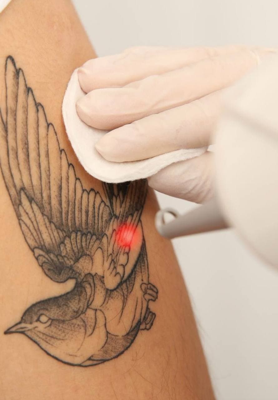 Tattoo and Permanent Makeup Removal