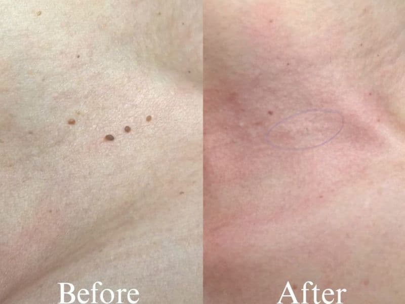 Skin Tag Removal